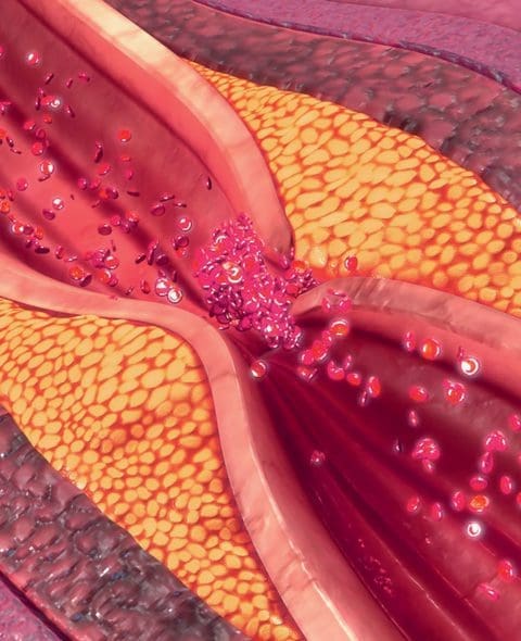 Critical Limb Ischemia treated at SCMSC, Los Angeles