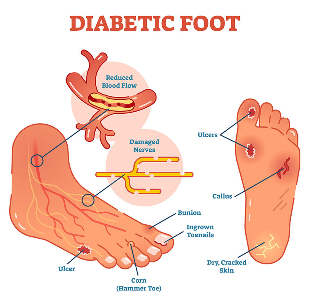 foot diagram showing the different causes of foot pain in a person with diabetes