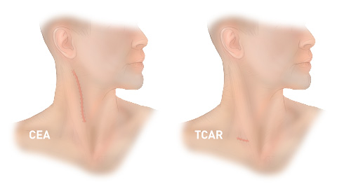 illustration of the large incision from carotid endarterectomy versus the minor incision from Transcarotid Artery Revascularization (TCAR) surgery being done at SCMSC in Los Angeles