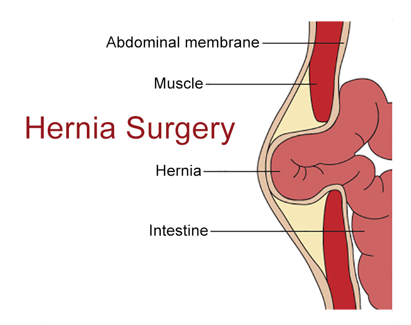Illustration of a hernia in an abdominal wall the hernia surgeon of SCMSC in Los Angeles treats