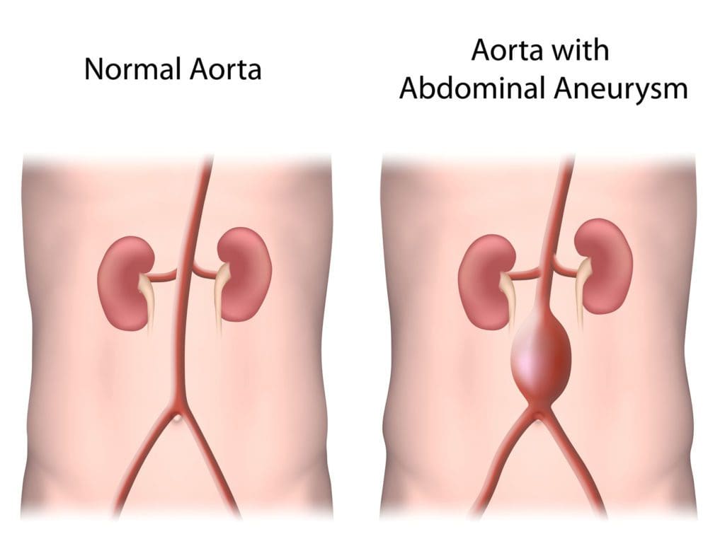 illustration of aorta with abdominal aortic aneurysm needing abdominal aortic aneurysm treatment