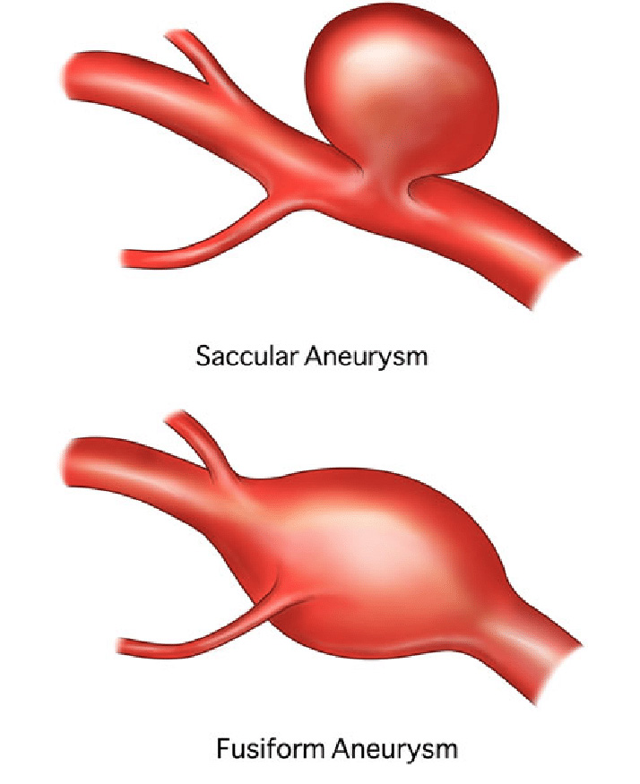 illustration of two types of abdominal aneurysm also known as stomach aneurysm 