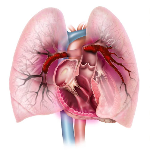 Image of  pulmonary embolism - large clots sitting in both lungs restricting blood flow.
