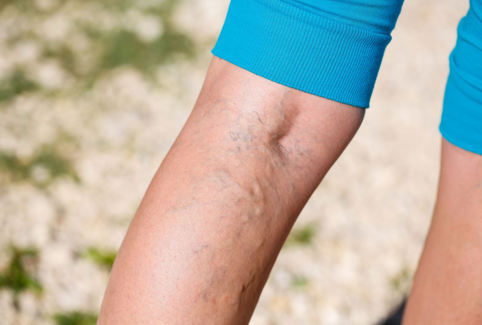leg showing symptoms of may thurner syndrome such as swollen veins