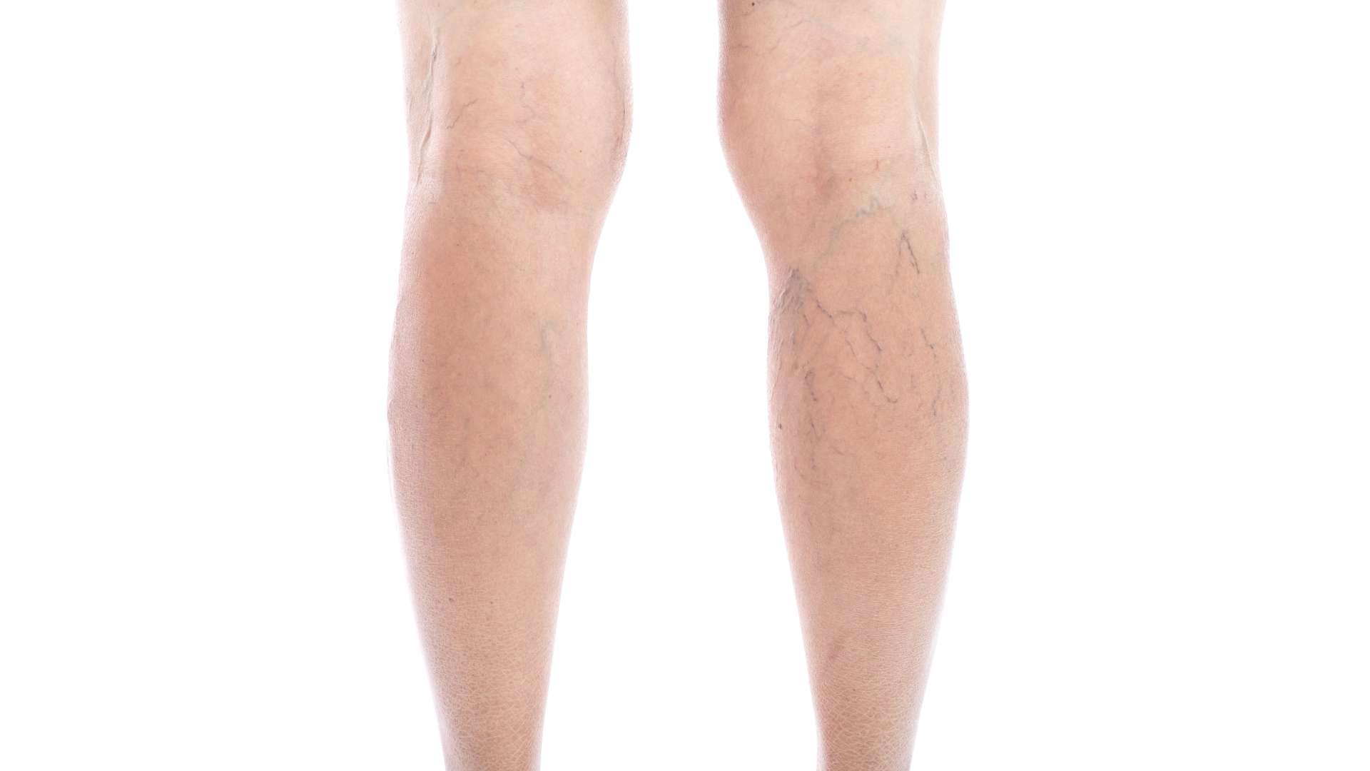 A Los Angeles person showing their legs with varicose veins or spider veins