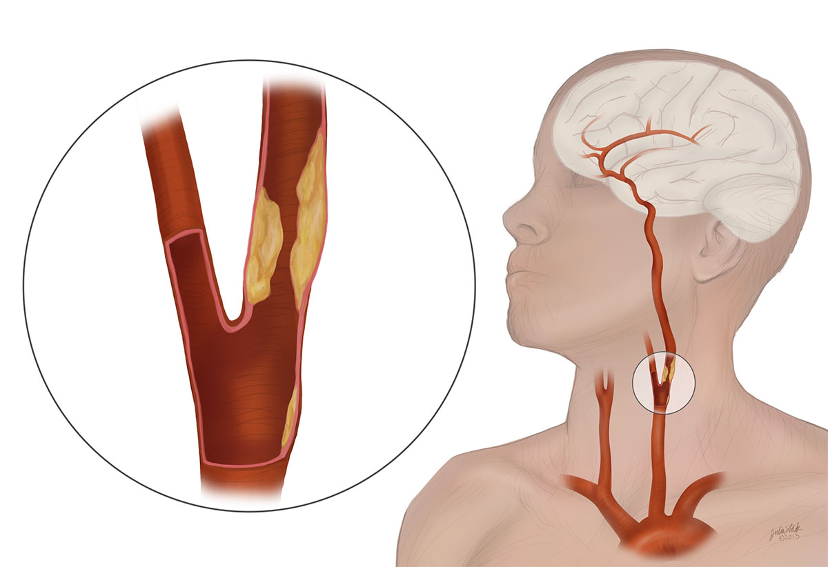Carotid Artery Disease illustration showing where the experts at SCMSC in Los Angeles would perform a carotid ultrasound