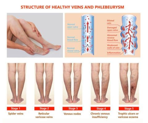 Chronic Venous Insufficiency treated at SCMSC