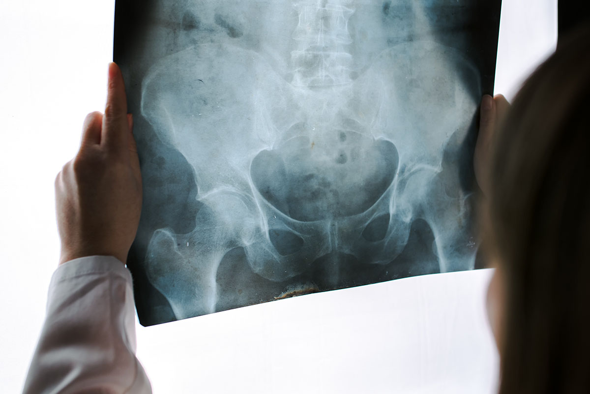doctor examining pelvis x-ray of patient exhibiting bone cancer symptoms