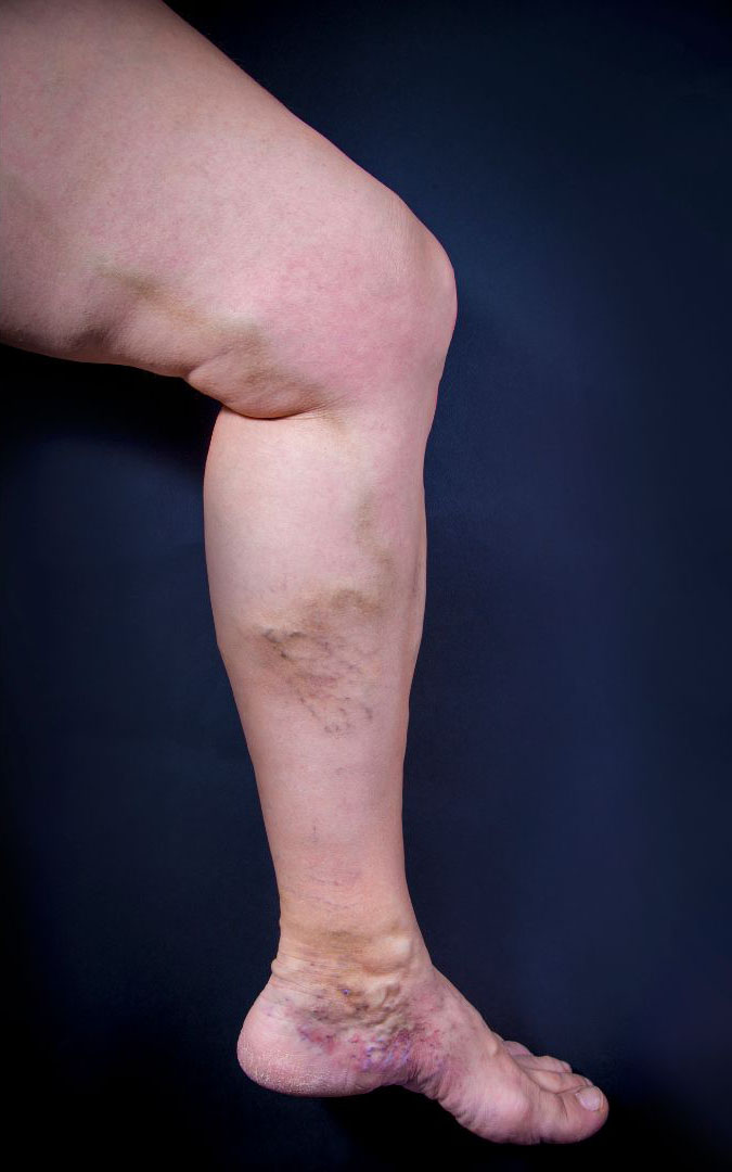 leg with symptoms of chronic venous insufficiency