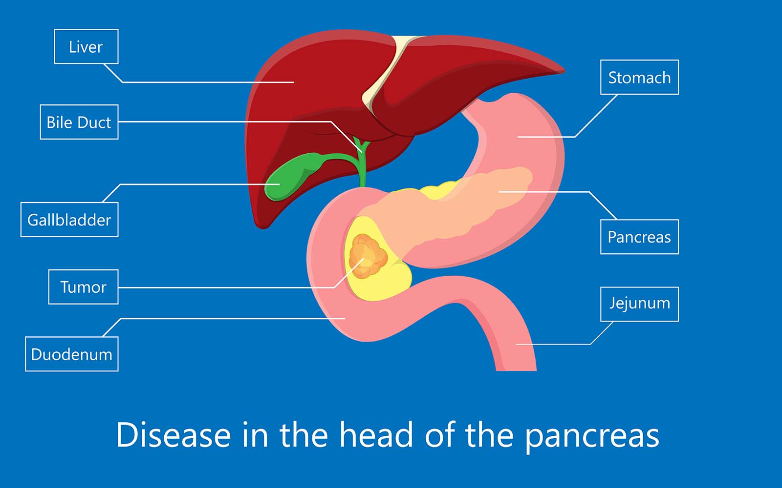 Illustration showing a tumor in the head of the pancreas