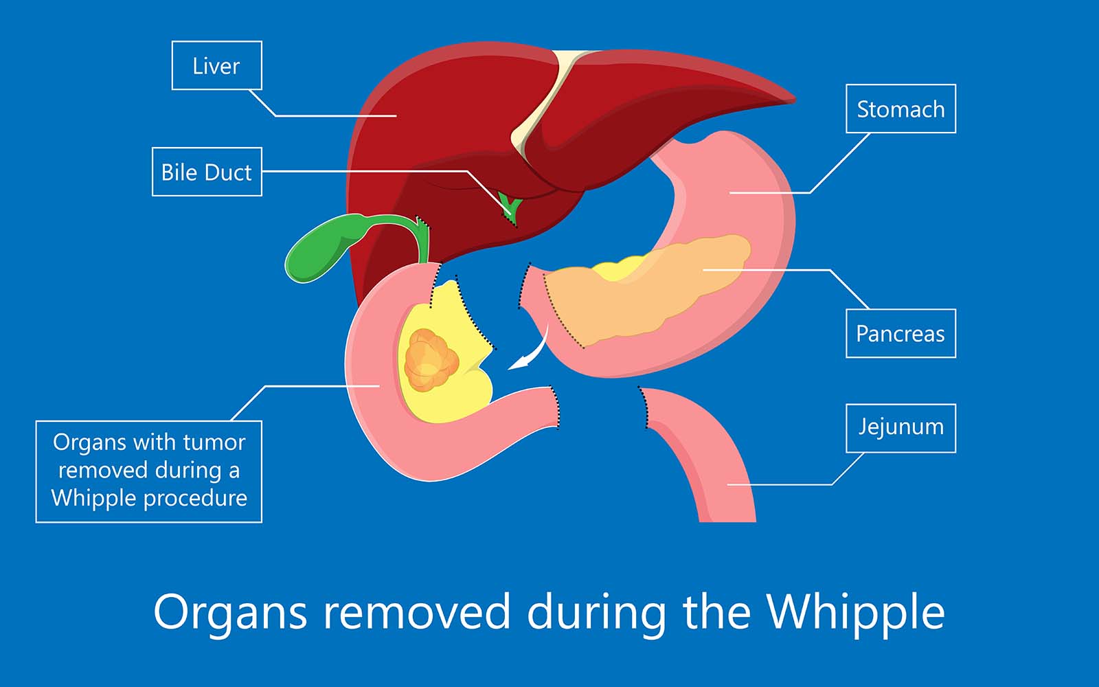 Illustration of the organs removed during the Whipple surgery procedure