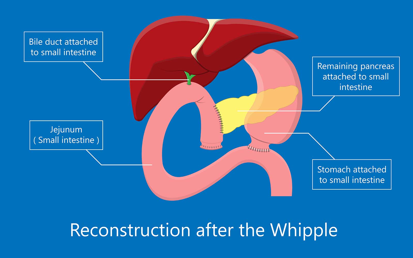 Illustration of reconstruction after Whipple surgery procedure