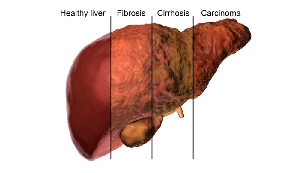 SCMSC has a comprehensive surveillance program for non-alcoholic fatty liver disease to identify and intervene if the disease progresses to hepatocellular cancer.
