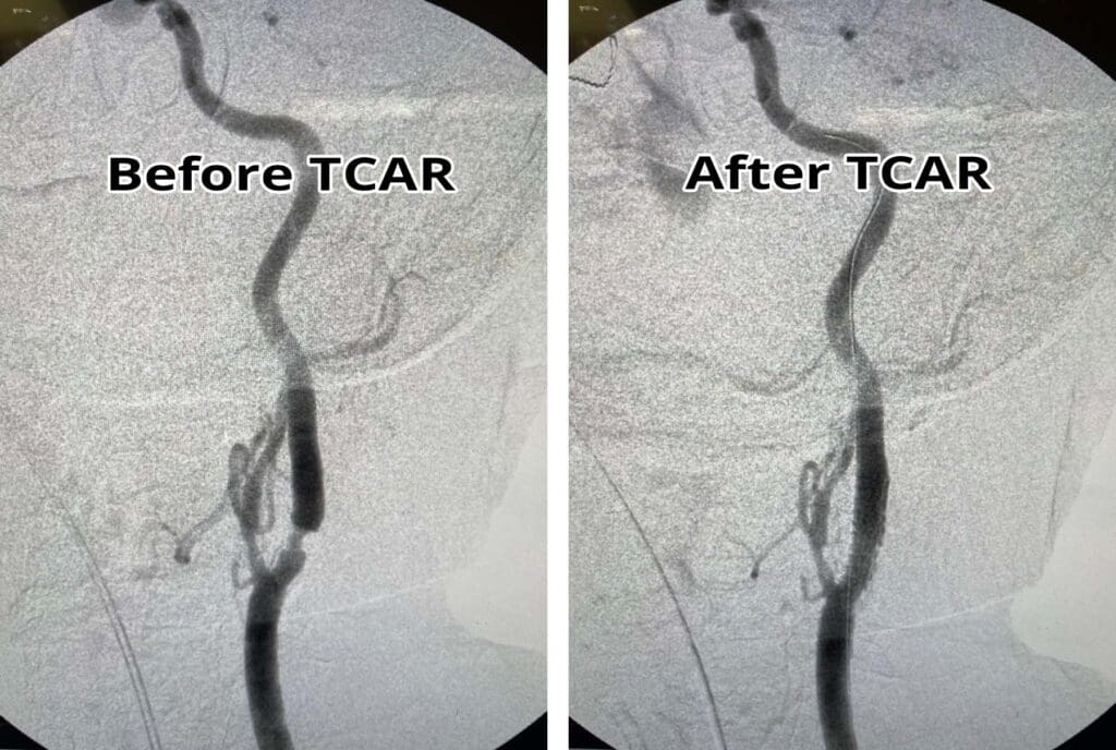 Angiographic x-ray images from a TCAR procedure.