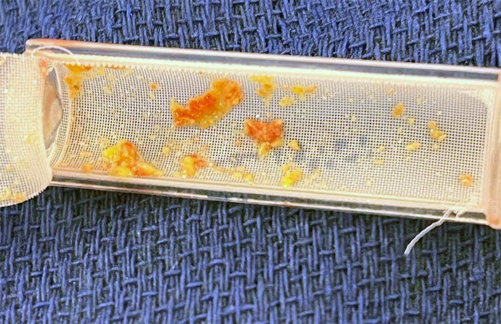 A filter from a TCAR case with plaque that was dislodged during the procedure and removed with the filtration process