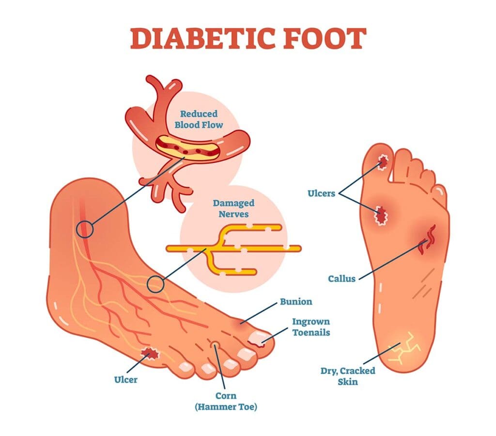 Diabetic Foot Ulcers treated at SCMSC in Los Angeles