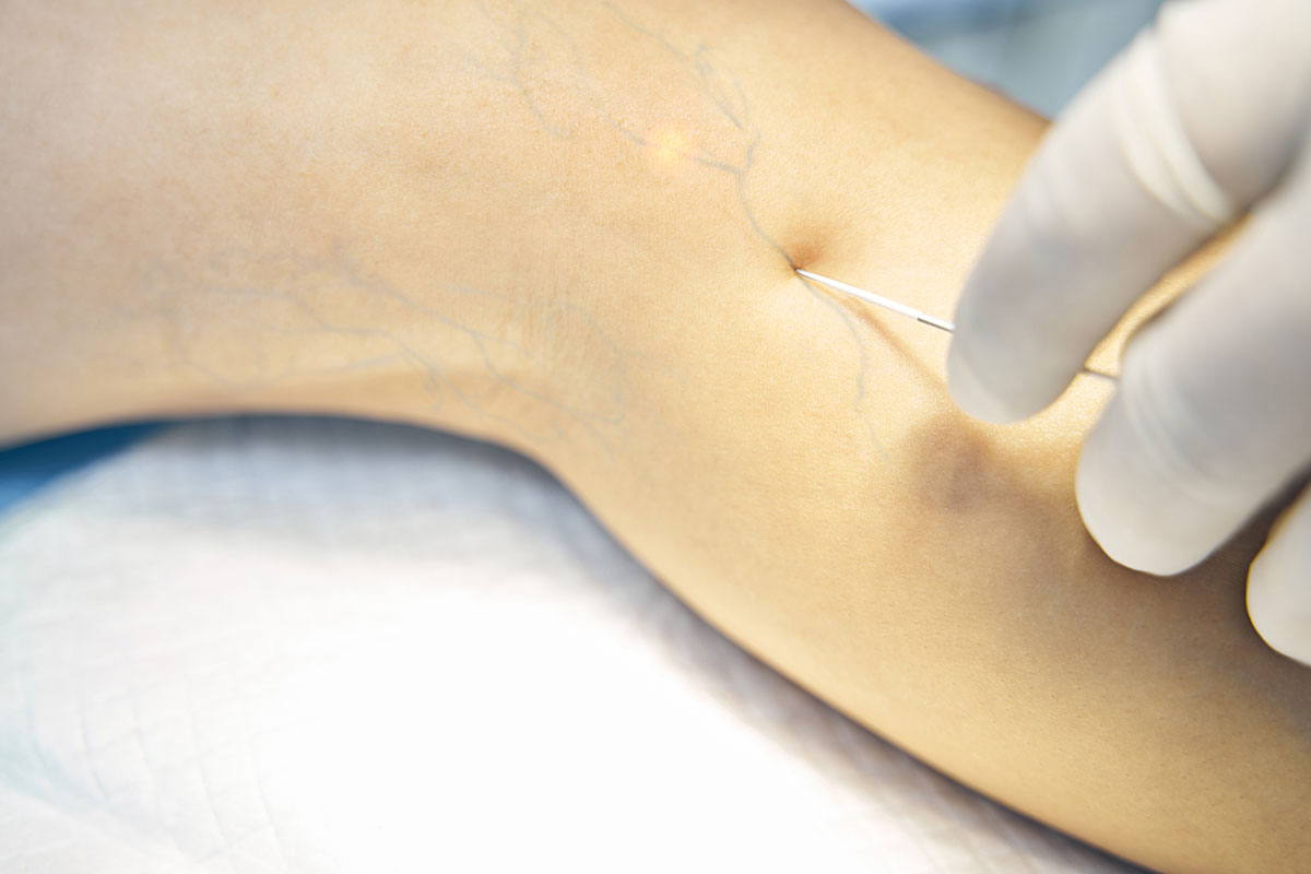 Minimally invasive endovascular procedures include varicose veins treatment