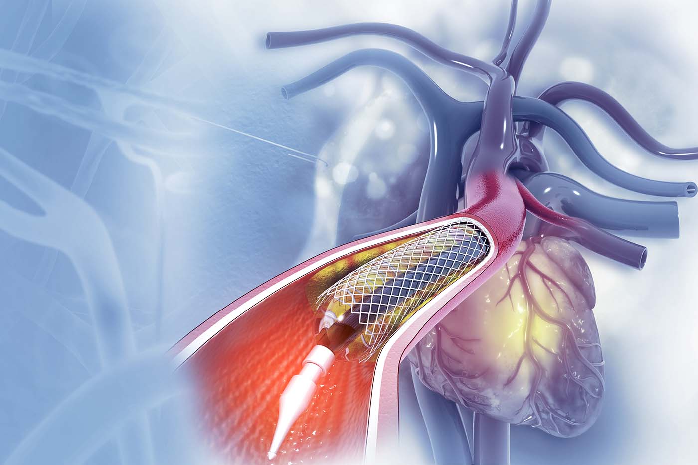 Balloon angioplasty procedure with stent in vein 3d illustration