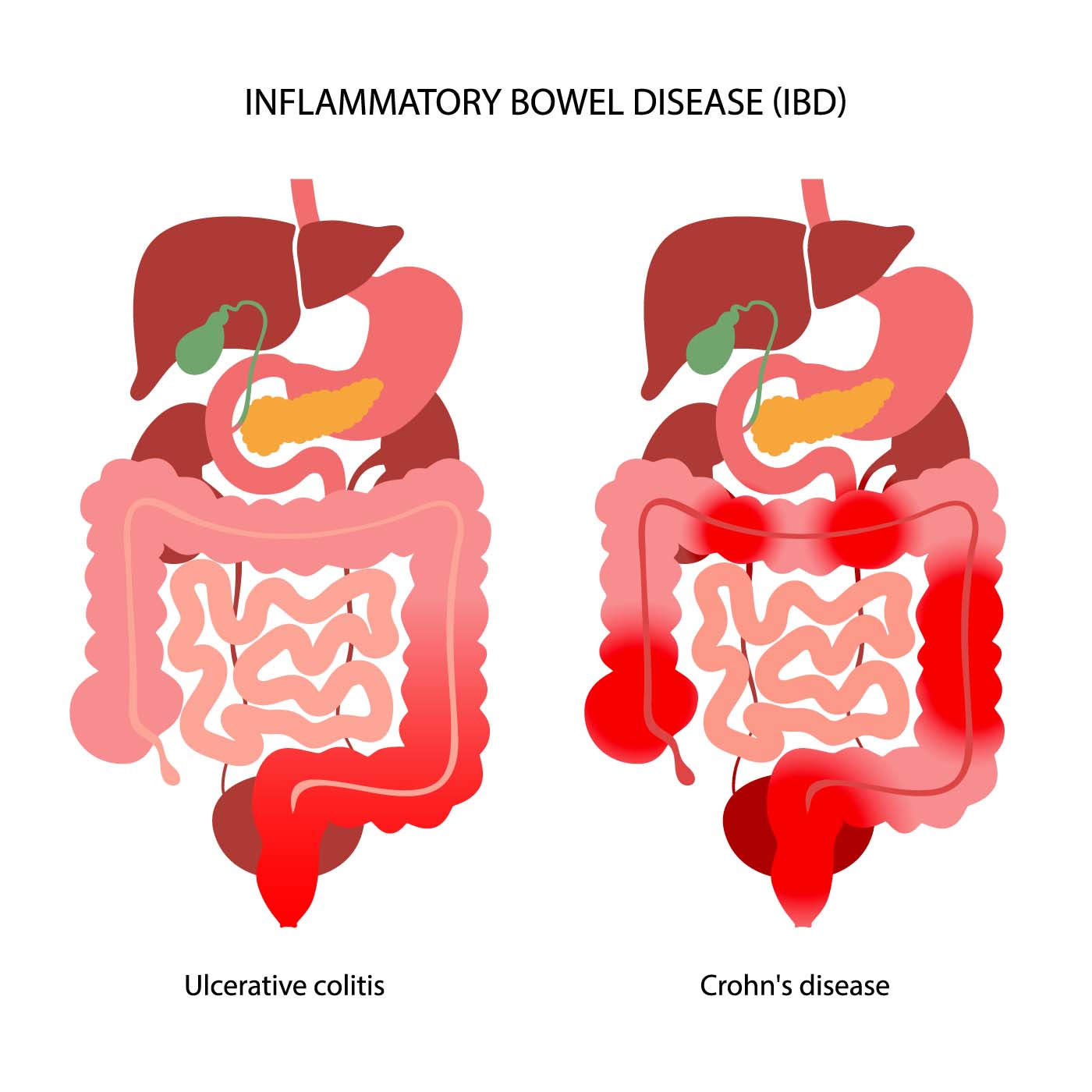 Illustration of IBD showing difference between Ulcerative Colitis and Crohn's Disease Illustration of IBD showing difference between Ulcerative Colitis and Crohn's Disease