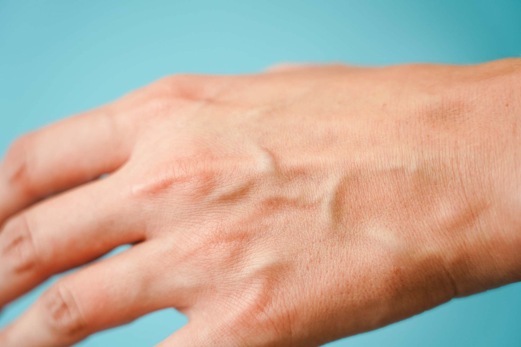 The image presents a close-up view of the dorsal side of a human hand with prominent superficial veins visible against a light blue background.