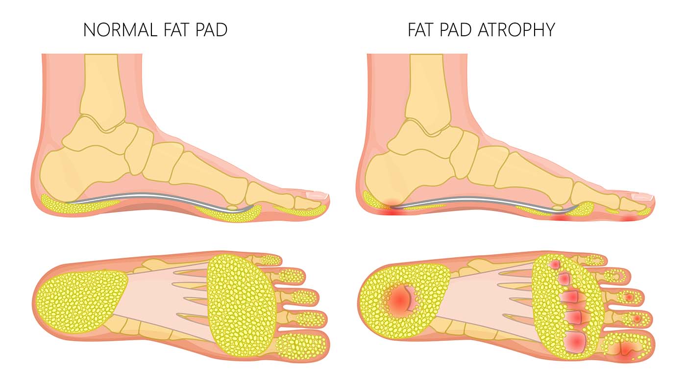 Illustrations of normal foot fat pad vs fat pad atrophy